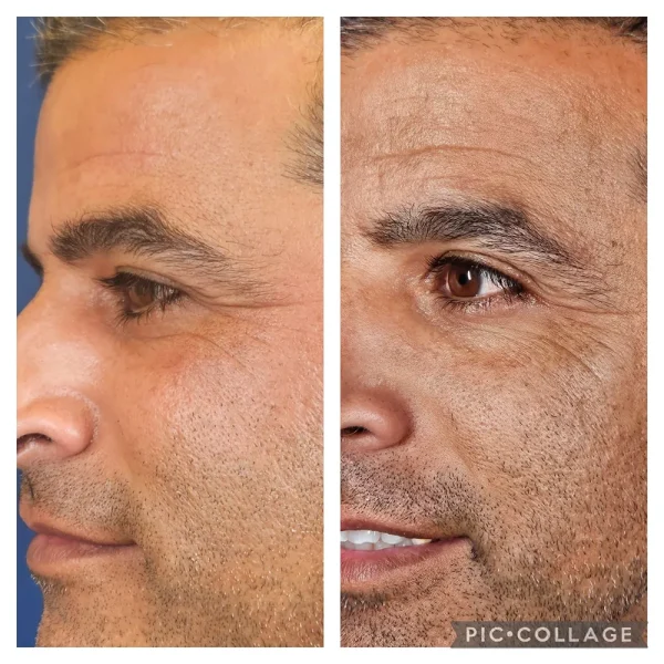 אקסוזום לפני אחרי 1