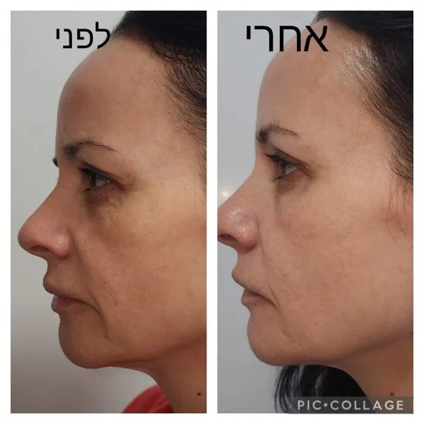 אקסוזום לפני אחרי 3